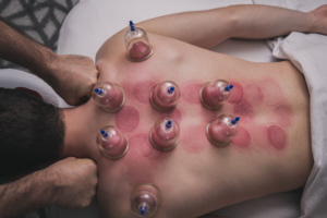 cupping sacramento massage