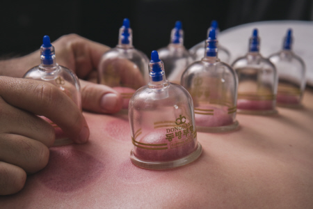 Cupping Massage Sacramento