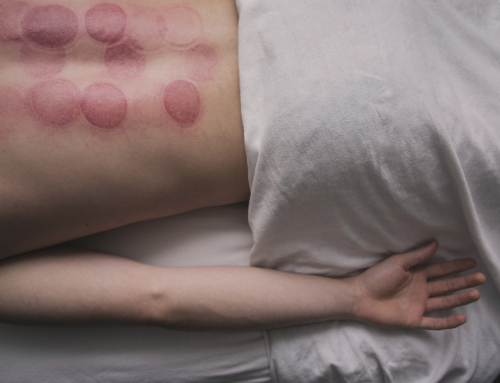 6 Essential Insights for Cupping Newbies